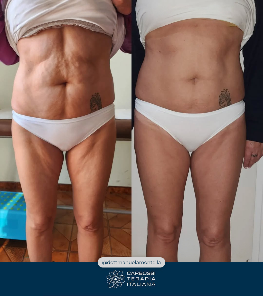 Un altro eccellente lavoro svolto dalla nostra cara @dottemanuelamontella, che grazie all’utilizzo della nostra #Carbossiterapia (e al supporto di alimentazione e movimento) è riuscita in 5 sedute a donare alla sua paziente un risultato eccellente! 🦵🍊Visitate il suo profilo per poter ammirare altri suoi lavori 👉 https://www.facebook.com/dottemanuelamontellaNon avete ancora introdotto la Carbossiterapia nel vostro studio? Contattateci: vi si aprirà un mondo di possibilità per la bellezza e la salute dei vostri pazienti!#CarbossiterapiaItaliana***#provacostume #dottssaemanuelamontella #belle #gambe #avellino #medicina #medicinaestetica